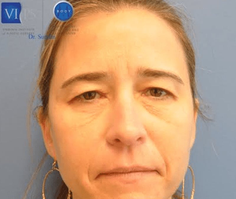 Eyelid Surgery Before & After Gallery - Patient 55345620 - Image 1