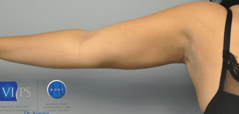 Renuvion J-Plasma Before & After Gallery - Patient 211876559 - Image 2