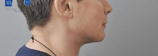 Facelift Before & After Gallery - Patient 55345621 - Image 6