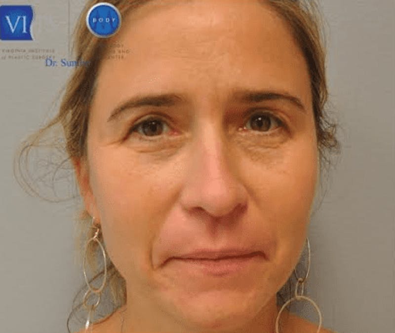 Eyelid Surgery Before & After Gallery - Patient 55345620 - Image 2