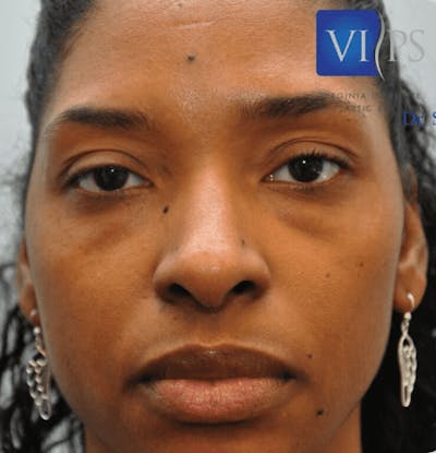 Eyelid Surgery Before & After Gallery - Patient 55345624 - Image 1