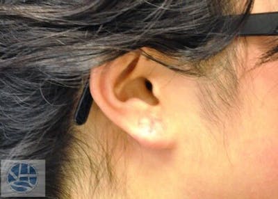 Gauged Earlobes Before & After Gallery - Patient 55345623 - Image 2