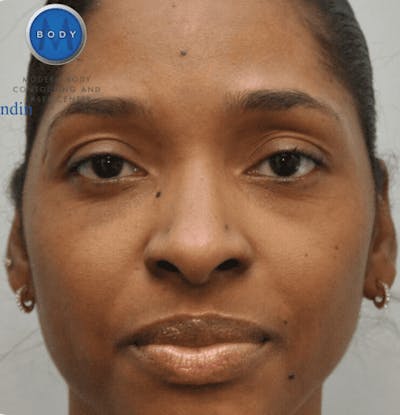 Eyelid Surgery Before & After Gallery - Patient 55345624 - Image 2