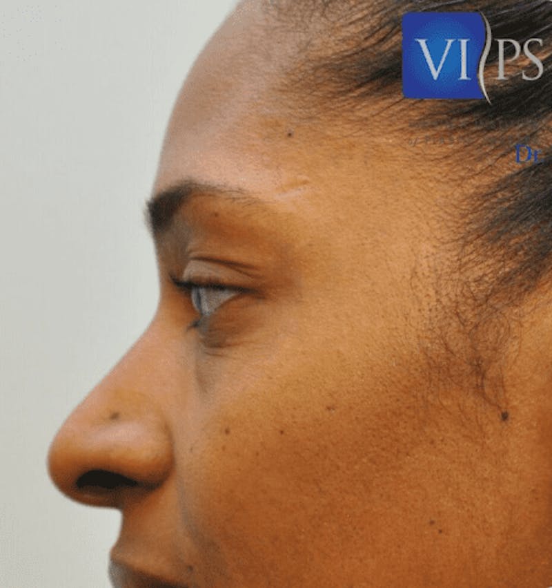 Eyelid Surgery Before & After Gallery - Patient 55345624 - Image 3