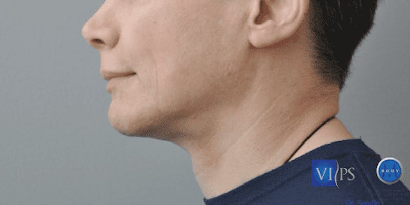 Facelift Before & After Gallery - Patient 55345621 - Image 10