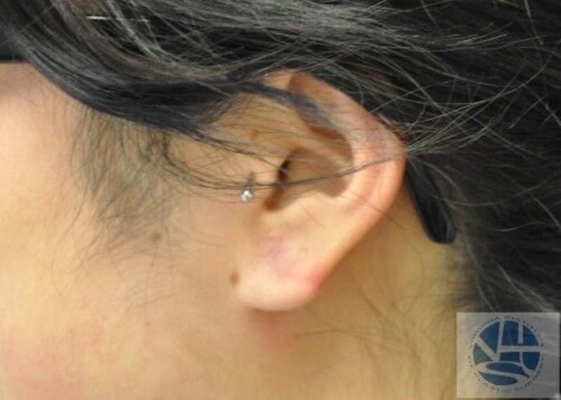 Gauged Earlobes Before & After Gallery - Patient 55345623 - Image 4