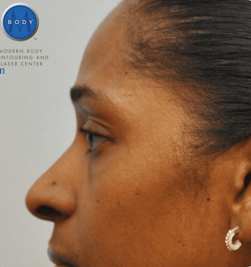 Eyelid Surgery Gallery - Patient 55345624 - Image 4