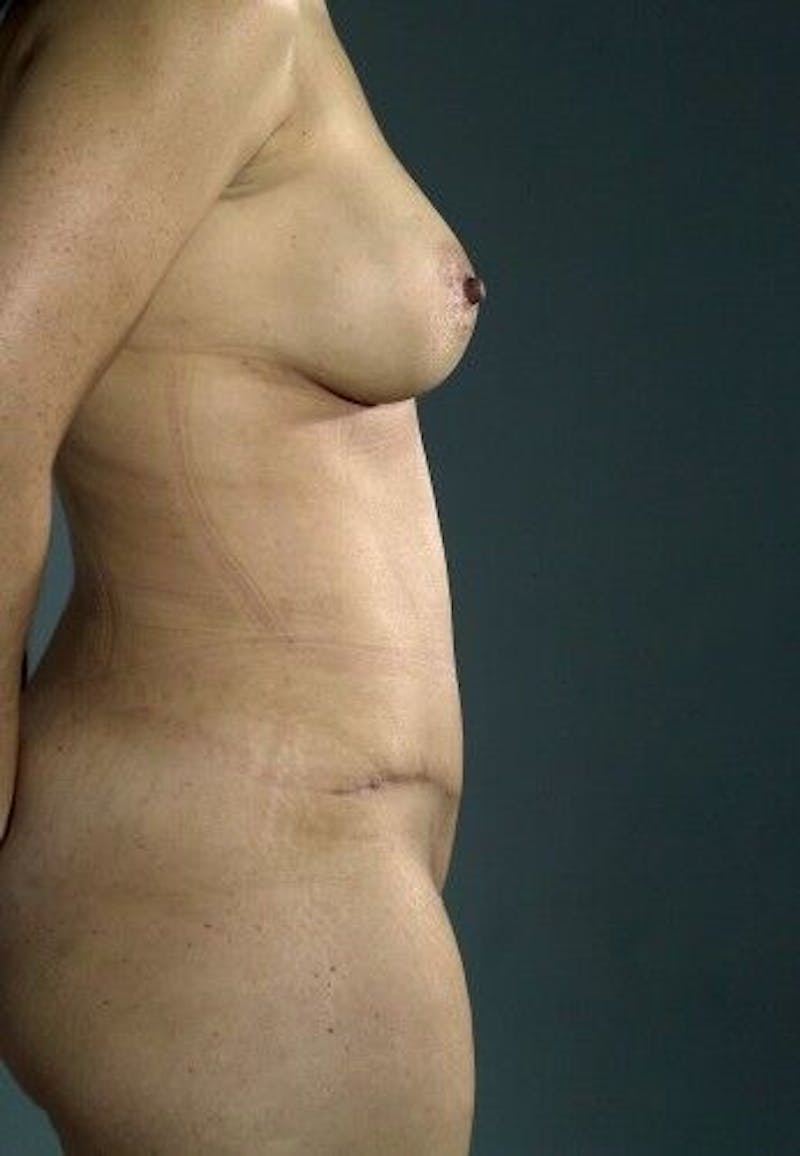 Tummy Tuck Before & After Gallery - Patient 55345625 - Image 8