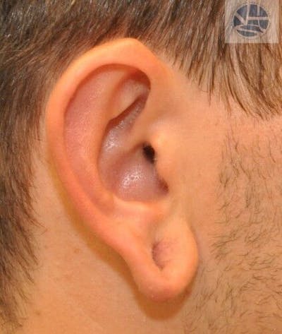 Gauged Earlobes Before & After Gallery - Patient 55345627 - Image 1