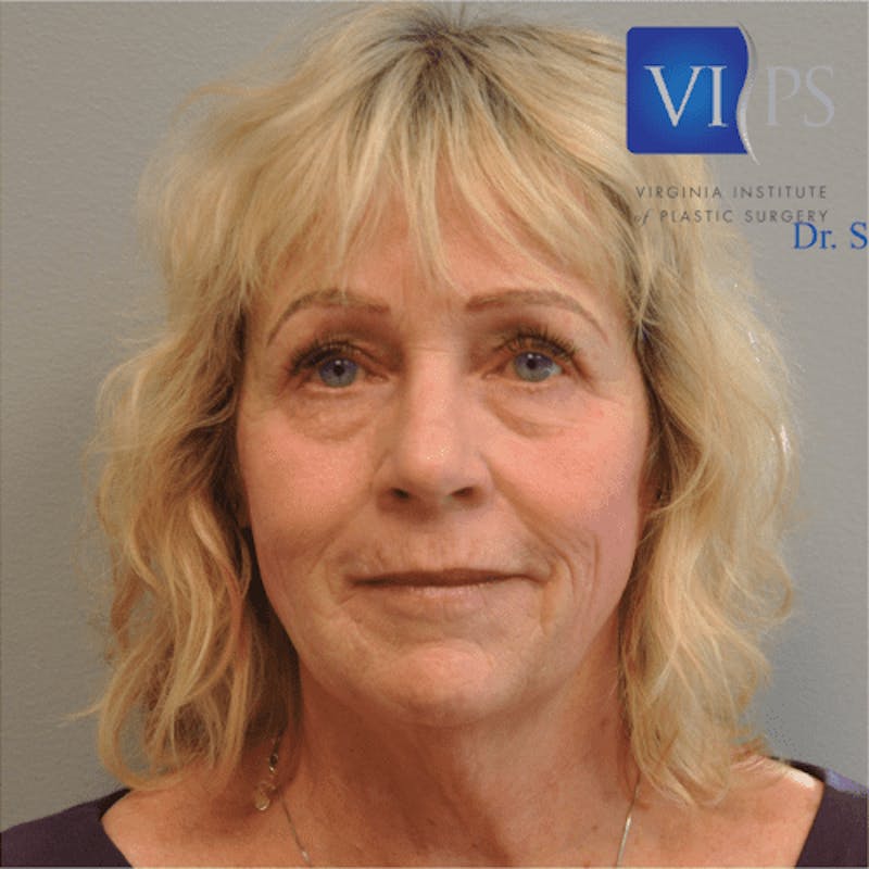 Facelift Before & After Gallery - Patient 55345640 - Image 1