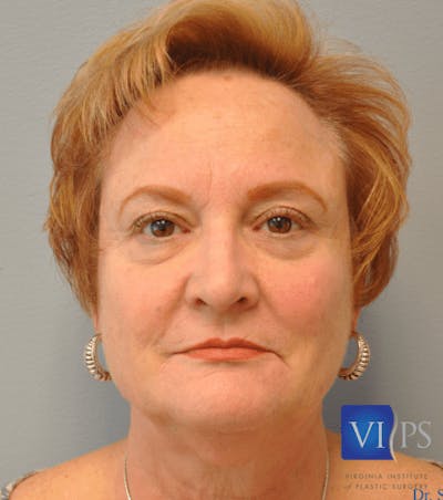 Eyelid Surgery Before & After Gallery - Patient 55345631 - Image 1