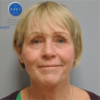 Facelift Before & After Gallery - Patient 55345640 - Image 2