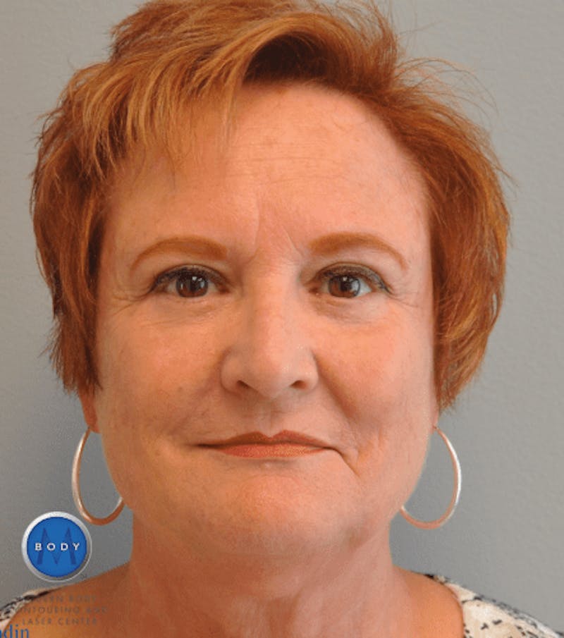 Eyelid Surgery Before & After Gallery - Patient 55345631 - Image 2