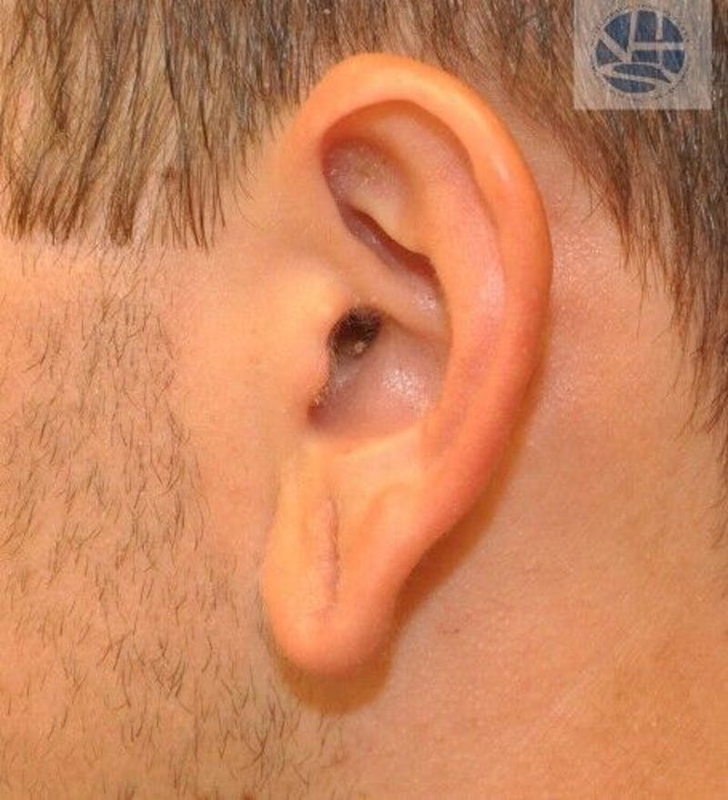Gauged Earlobes Before & After Gallery - Patient 55345627 - Image 3