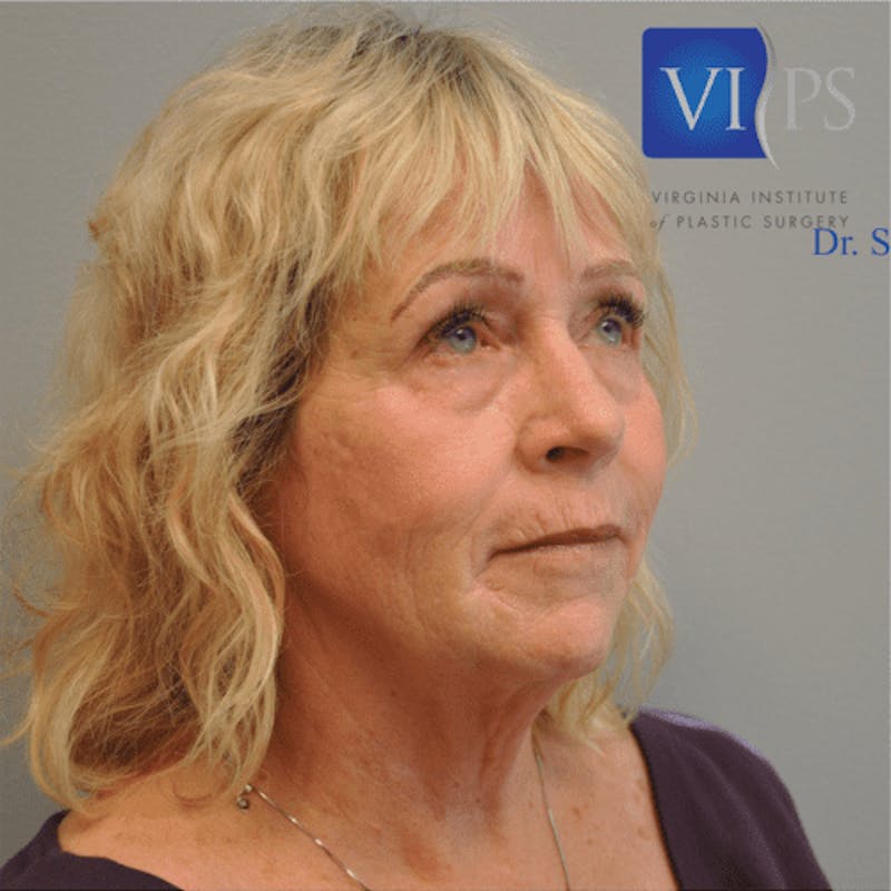 Facelift Before & After Gallery - Patient 55345640 - Image 3