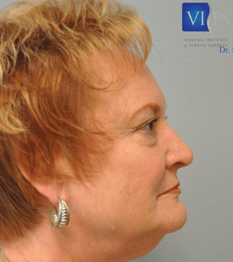 Eyelid Surgery Before & After Gallery - Patient 55345631 - Image 3