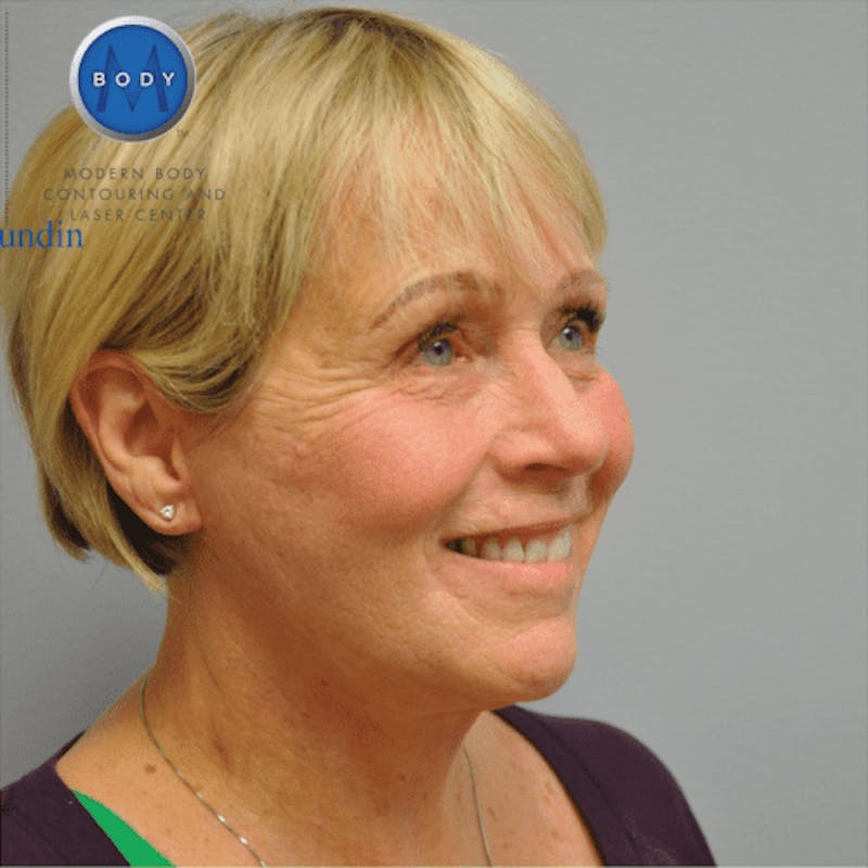 Facelift Before & After Gallery - Patient 55345640 - Image 4