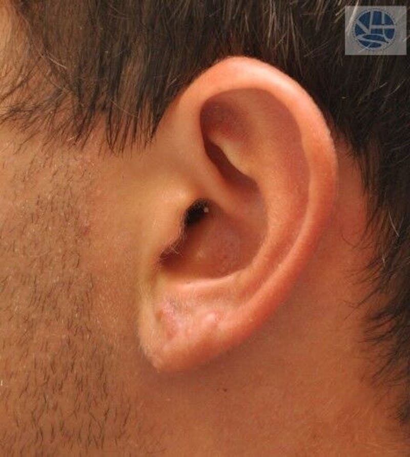 Gauged Earlobes Before & After Gallery - Patient 55345627 - Image 4