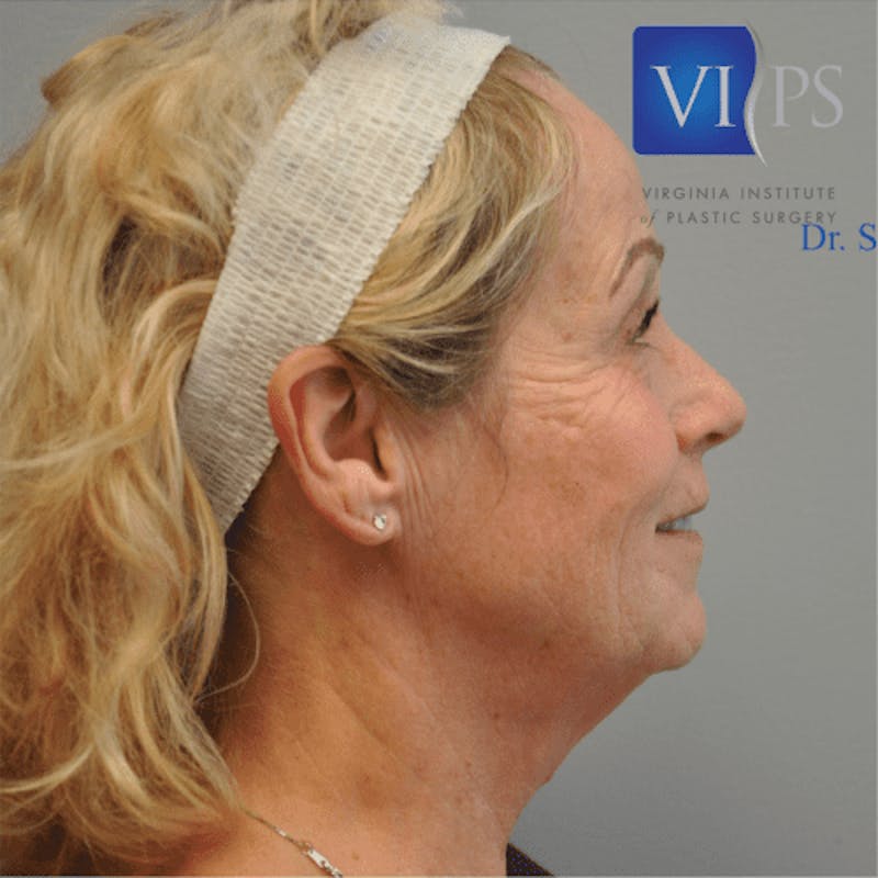 Facelift Before & After Gallery - Patient 55345640 - Image 5
