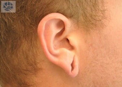 Gauged Earlobes Before & After Gallery - Patient 55345634 - Image 1