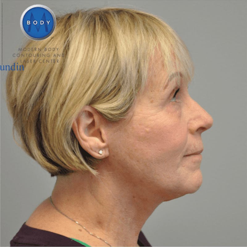 Facelift Before & After Gallery - Patient 55345640 - Image 6