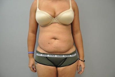 Tummy Tuck Before & After Gallery - Patient 55345644 - Image 1