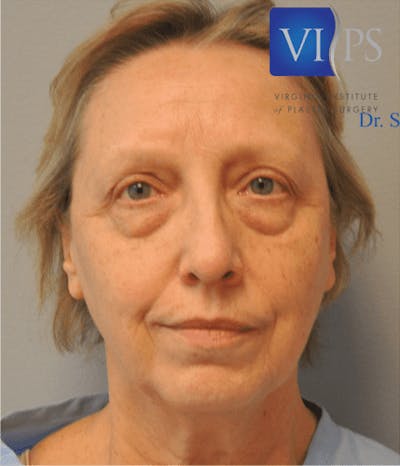 Eyelid Surgery Gallery - Patient 55345641 - Image 1