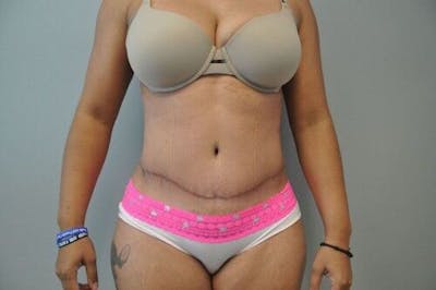 Tummy Tuck Before & After Gallery - Patient 55345644 - Image 2