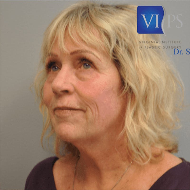 Facelift Before & After Gallery - Patient 55345640 - Image 7