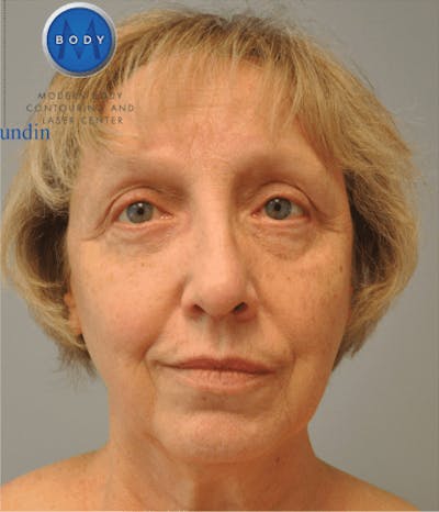 Eyelid Surgery Gallery - Patient 55345641 - Image 2