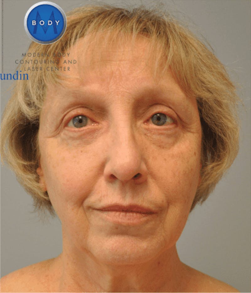 Eyelid Surgery Before & After Gallery - Patient 55345641 - Image 2