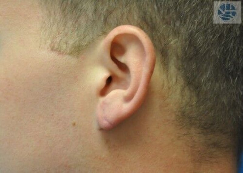 Gauged Earlobes Before & After Gallery - Patient 55345634 - Image 4