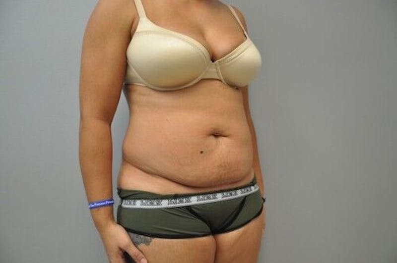 Tummy Tuck Before & After Gallery - Patient 55345644 - Image 3