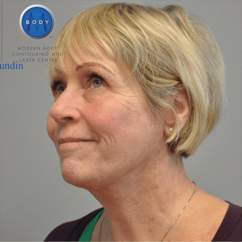 Facelift Before & After Gallery - Patient 55345640 - Image 8