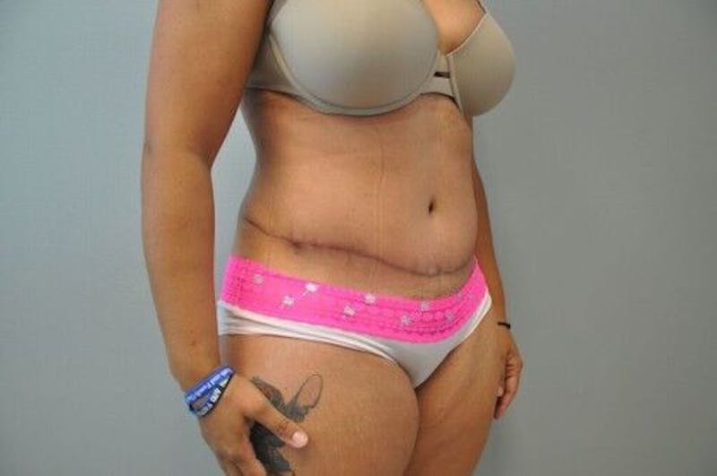 Tummy Tuck Before & After Gallery - Patient 55345644 - Image 4