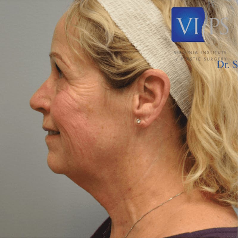 Facelift Before & After Gallery - Patient 55345640 - Image 9
