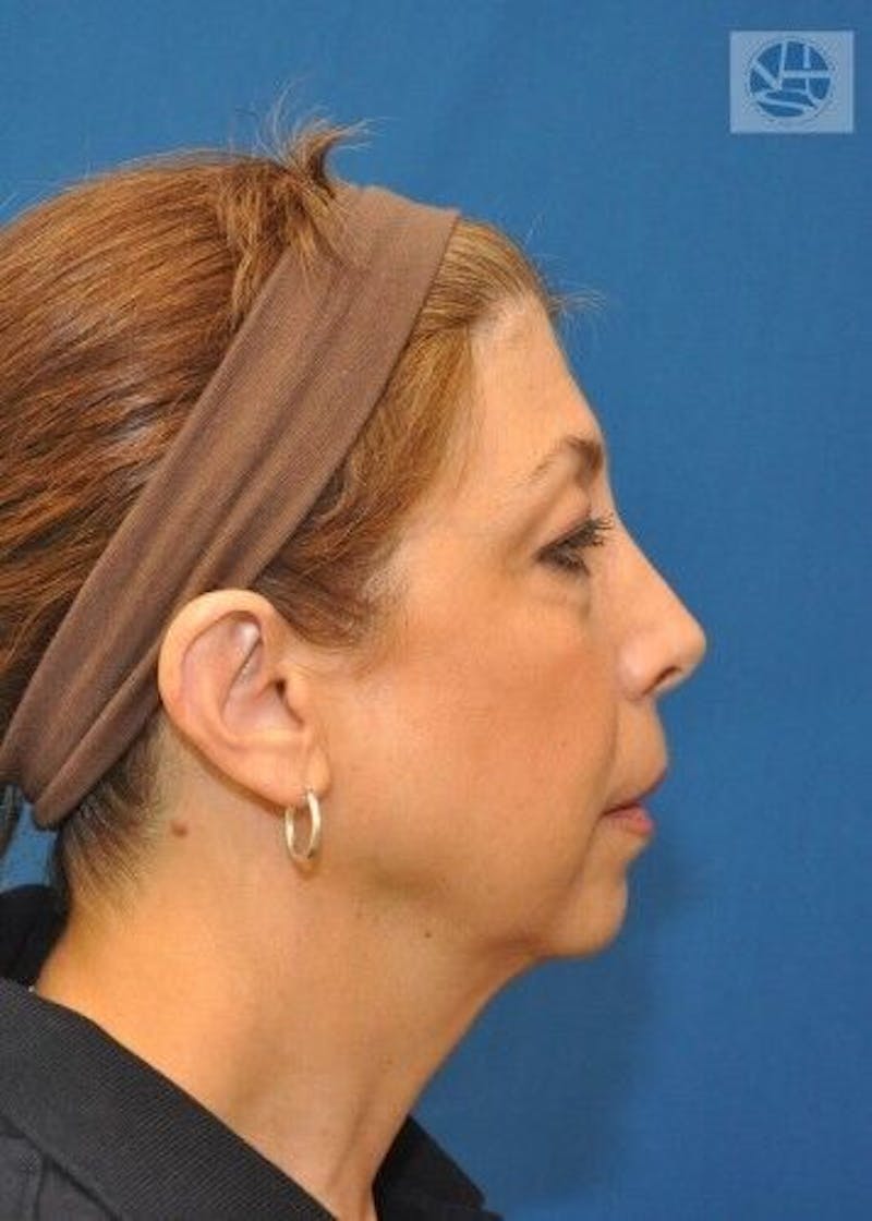 Neck Lift Before & After Gallery - Patient 55345642 - Image 1