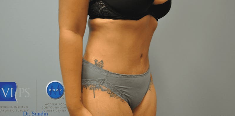 Liposuction Before & After Gallery - Patient 211876588 - Image 2