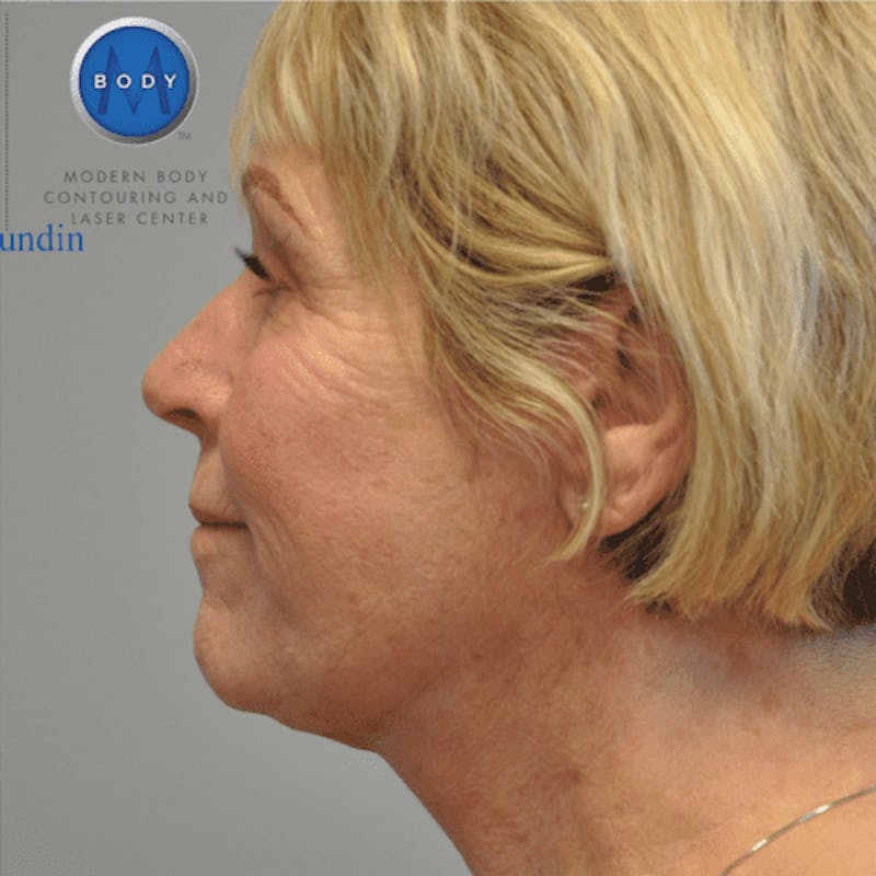 Facelift Before & After Gallery - Patient 55345640 - Image 10