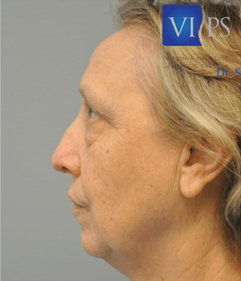 Eyelid Surgery Before & After Gallery - Patient 55345641 - Image 5