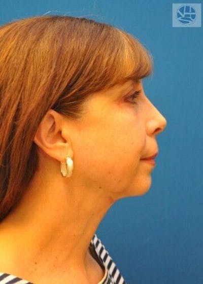 Neck Lift Before & After Gallery - Patient 55345642 - Image 2