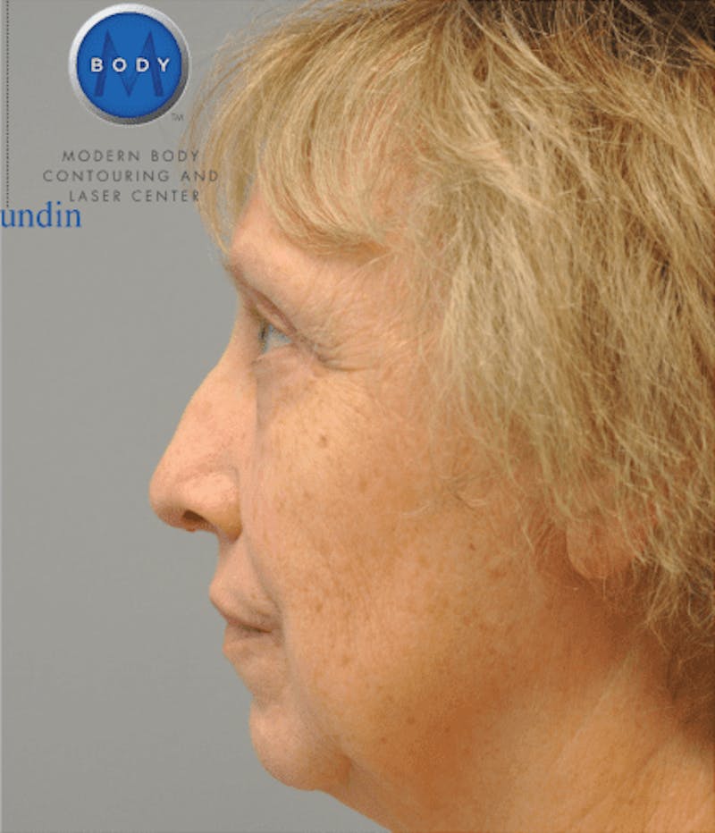 Eyelid Surgery Before & After Gallery - Patient 55345641 - Image 6