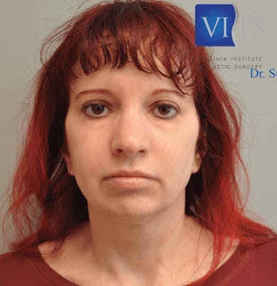 Facelift Before & After Gallery - Patient 55345651 - Image 1