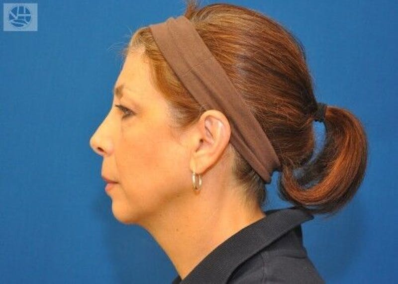Neck Lift Before & After Gallery - Patient 55345642 - Image 3