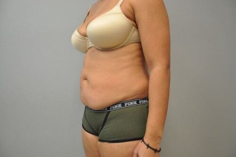 Tummy Tuck Before & After Gallery - Patient 55345644 - Image 7
