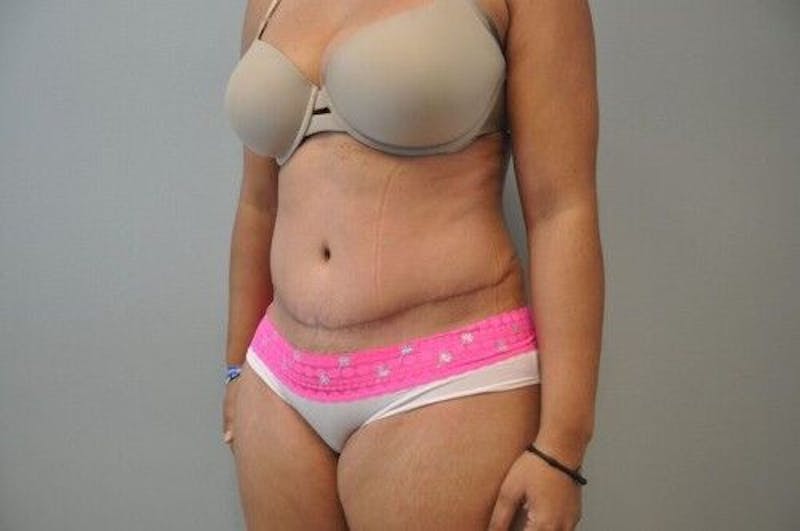 Tummy Tuck Before & After Gallery - Patient 55345644 - Image 8