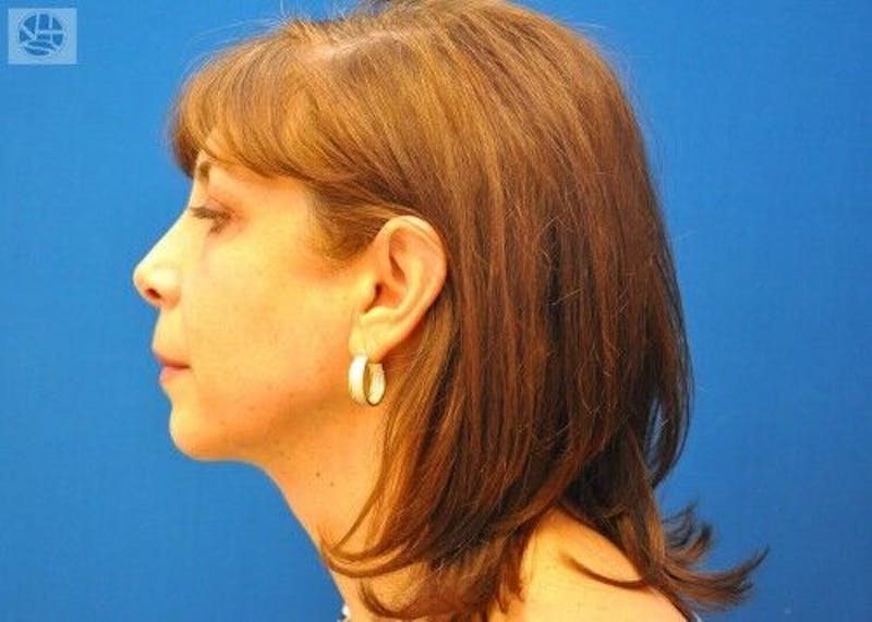 Neck Lift Before & After Gallery - Patient 55345642 - Image 4