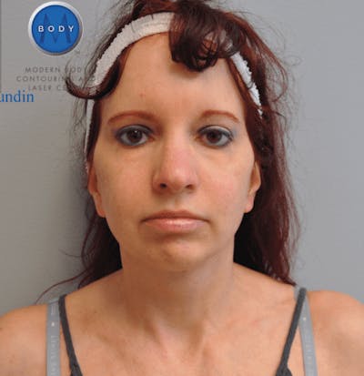 Facelift Before & After Gallery - Patient 55345651 - Image 2