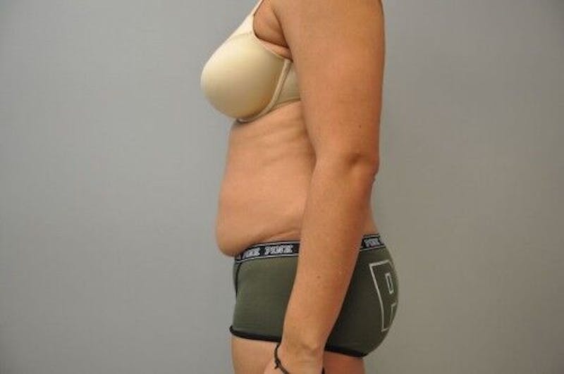 Tummy Tuck Before & After Gallery - Patient 55345644 - Image 9