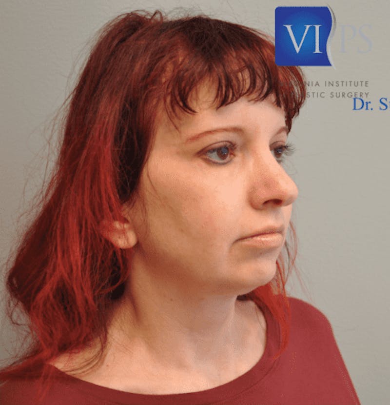 Facelift Before & After Gallery - Patient 55345651 - Image 3